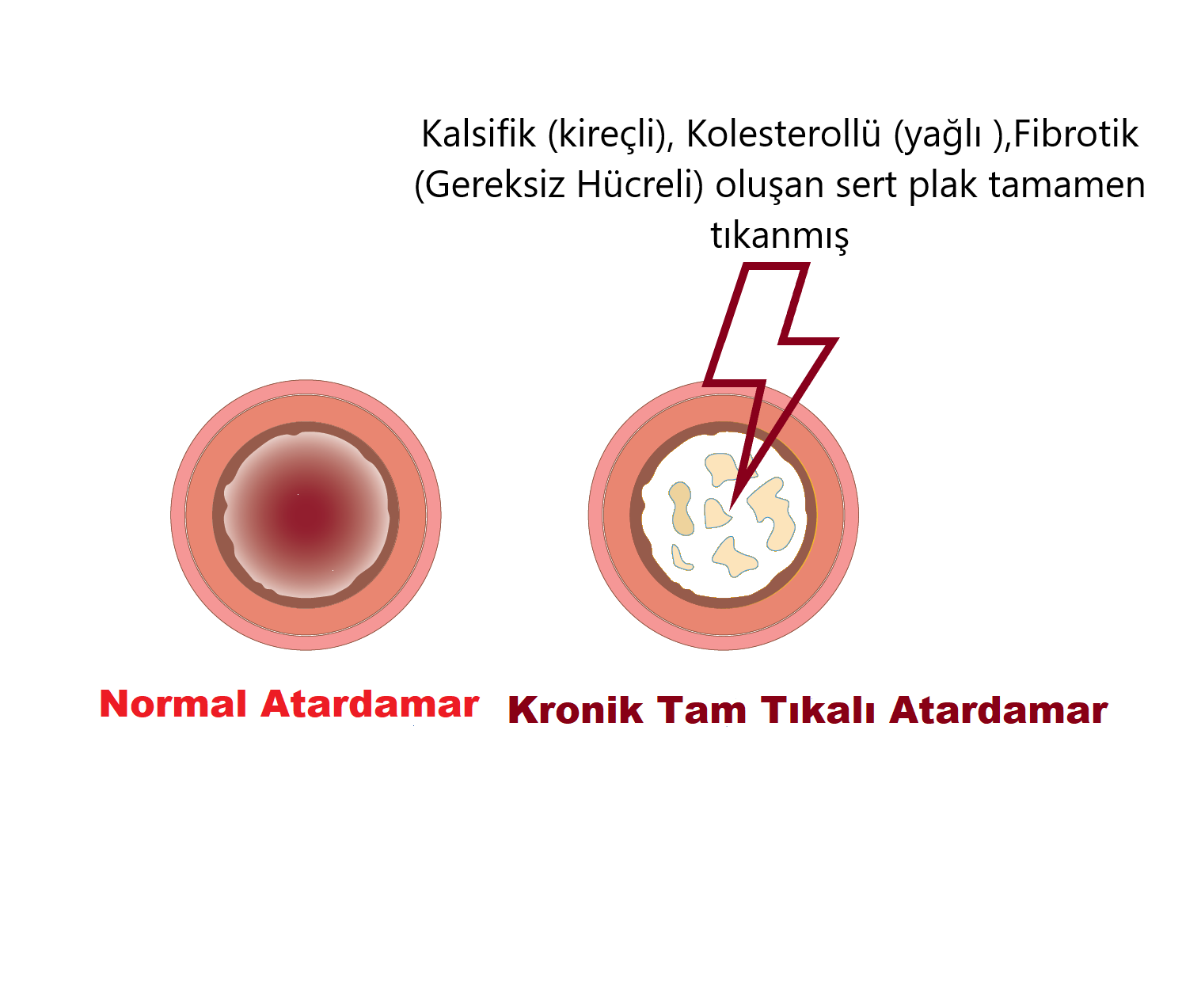 Normal ve Tıkalı atardamar 